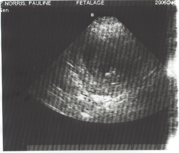 Ultrasound of our new baby.